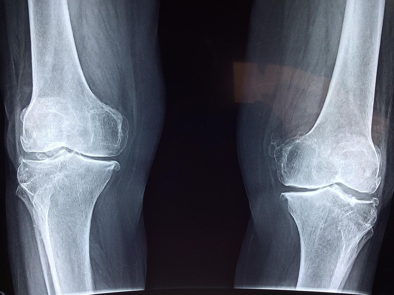 スライディング膝怪我を防ぐための効果的なリハビリ方法は？