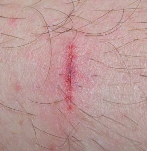 怪我の予防に効果的な方法は何ですか？
